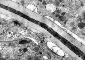 M,43y. | blood - degraded Candida (bone marrow suppression) M,43y. | blood - degraded Candida (bone marrow suppression)